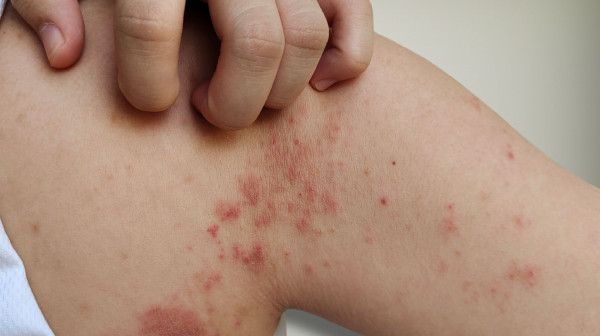 Impetigo se širi po Jadranu; Lekari upozoravaju: "Pridržavajte se ovih pravila"