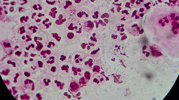 Opasna infekcija širi se Evropom: Polna bolest sve otpornija na antibiotike