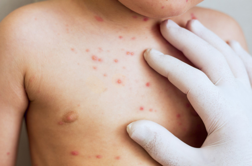Virus opet zabrinjava: Kako da prepoznate male boginje?