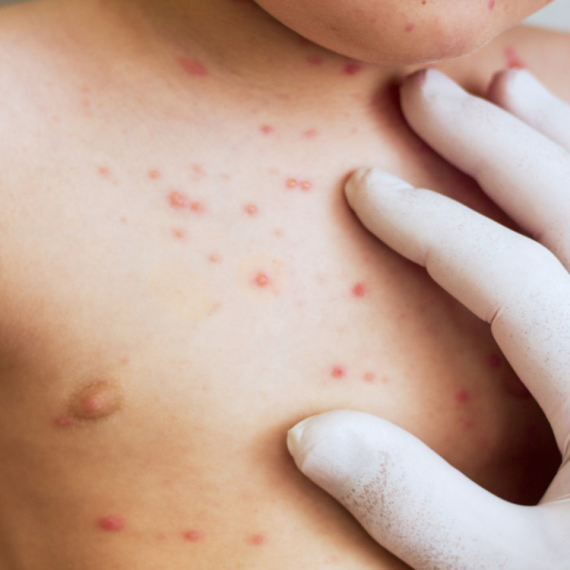Virus opet zabrinjava: Kako da prepoznate male boginje?
