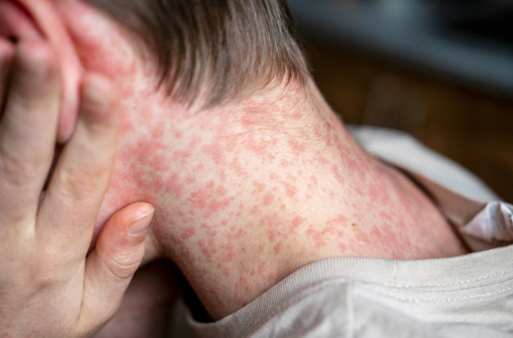 "Nije moguće okončati epidemiju malih boginja": Globalna pretnja po javno zdravlje