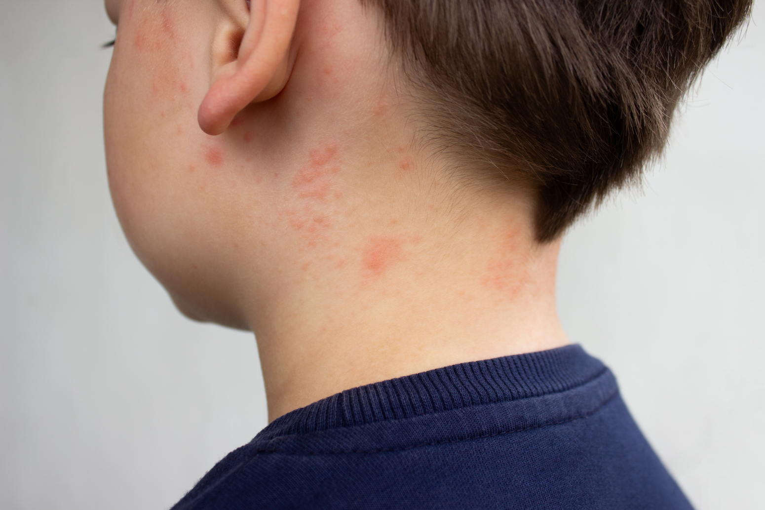 Nije svako crvenilo atopijski dermatitis; Doktorka otkrila najčešću grešku u lečenju