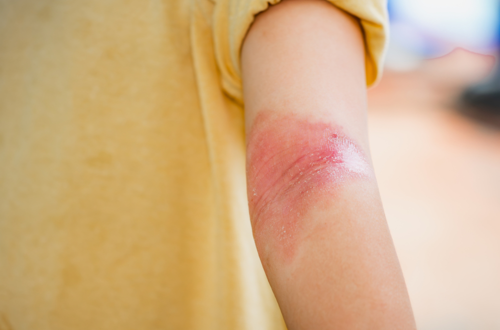 Nije svako crvenilo atopijski dermatitis; Doktorka otkrila najčešću grešku u lečenju