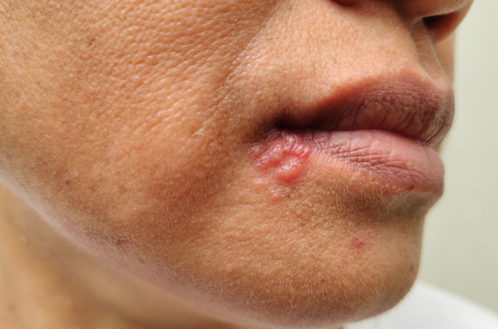 Virus koji milioni iaju: Herpes može da napravi haos u mozgu, čak i najteže bolesti