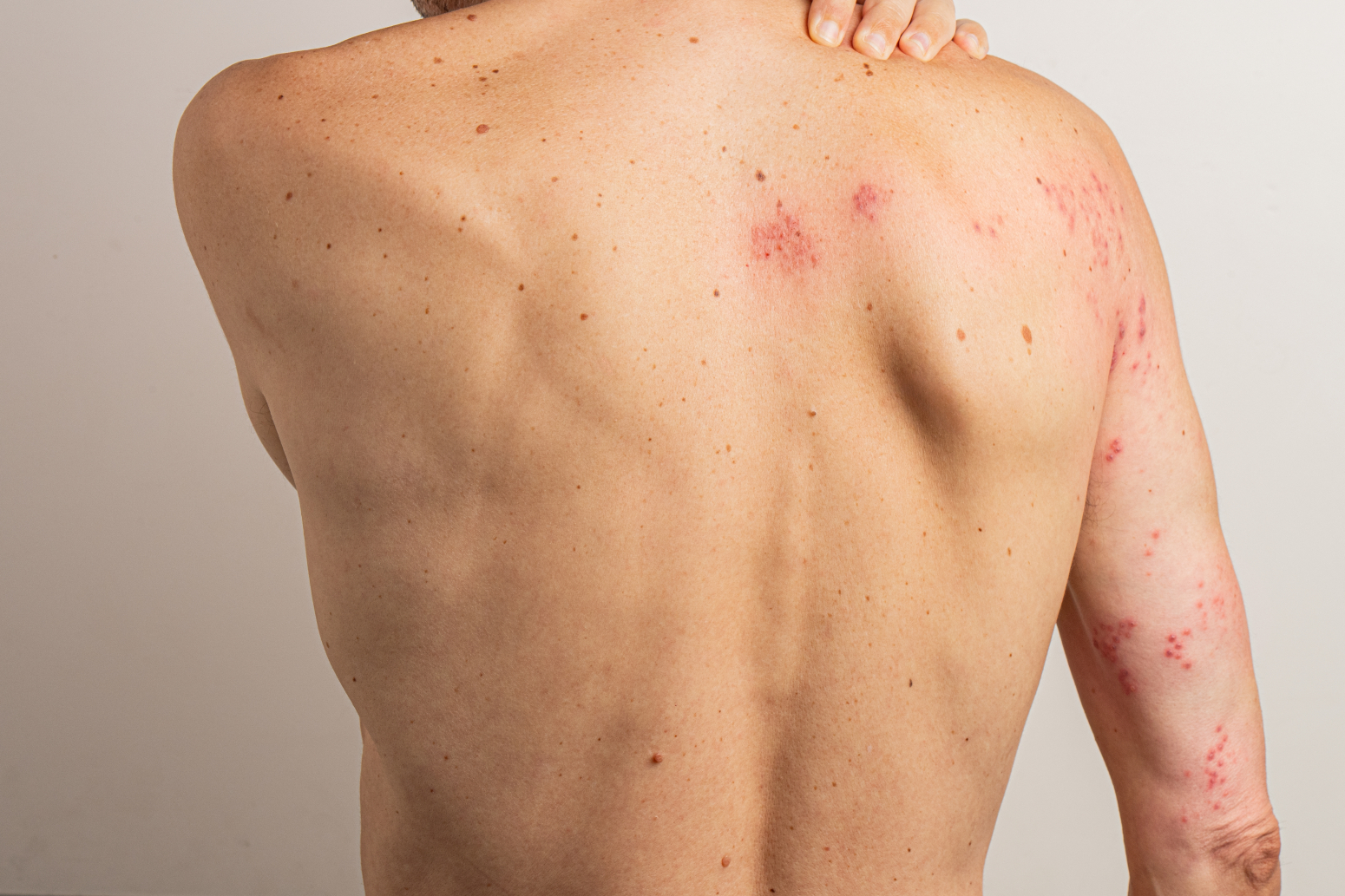 Virus koji milioni imaju: Herpes može da napravi haos u mozgu, čak i najteže bolesti