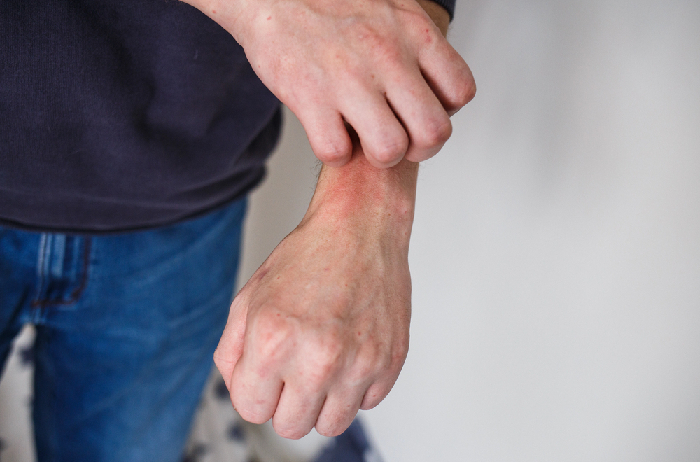 Zajedno protiv psorijaze: Edukacija i podrška na Svetski dan borbe