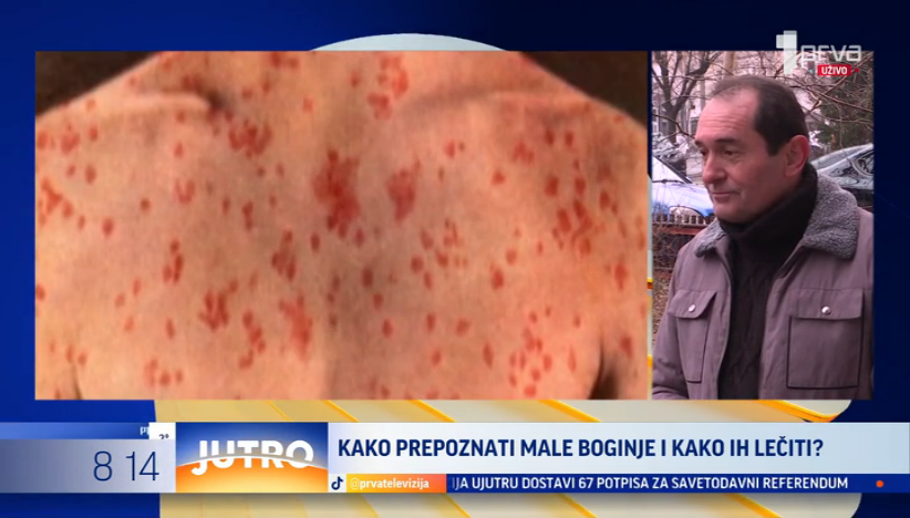 Koja je razlika između velikih i malih boginja?