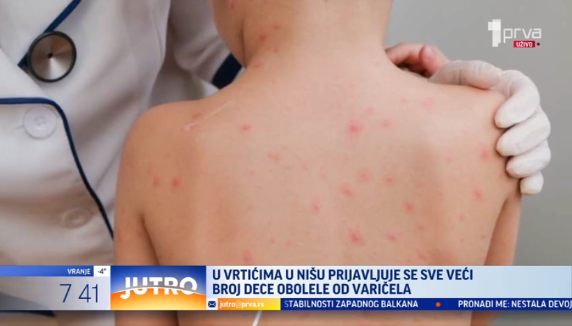 Sve veći broj niške dece ima boginje