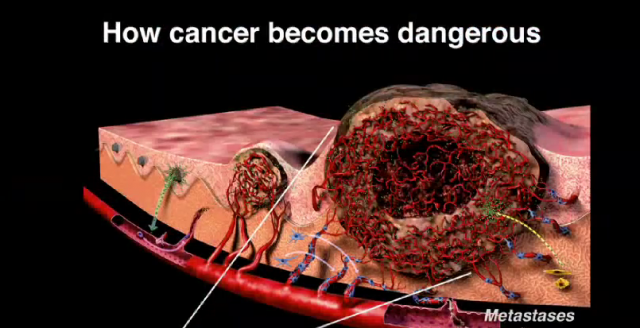 Svetski priznat nauènik tvrdi: Ovim namirnicama možete da "izgladnite" rak i lakše ga pobedite