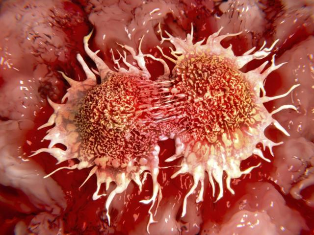 Lekari šokirani: Ovo ubija 93 odsto ćelija raka debelog creva za samo dva dana?