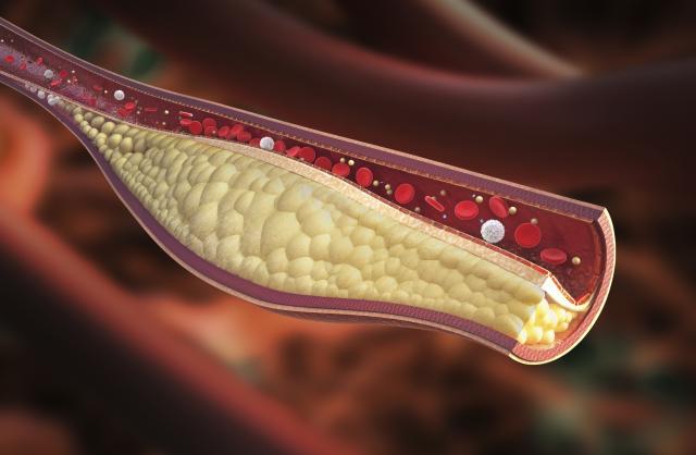 Zbogom lošem holesterolu i zaèepljenim arterijama: Najzdraviji prirodni napitak