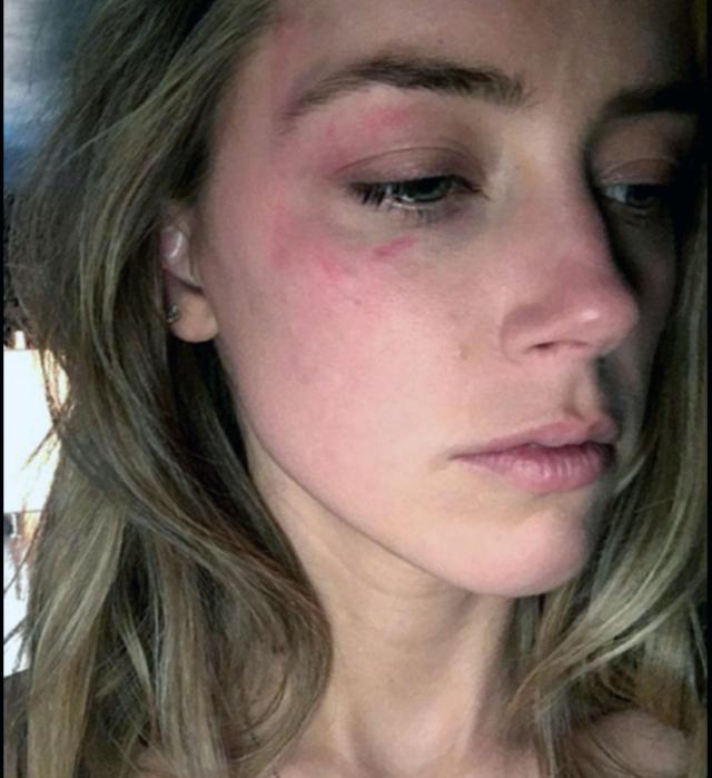 Skandalozna potvrda nasilja Džonija Depa: Pojavile se nove fotografije pretučene Amber Herd