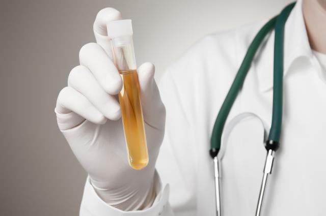 Šta boja urina otkriva o vašem zdravlju: Evo kako da saznate da li bolujete od nečega