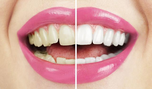Izbelite zube na prirodan način za manje od dva minuta
