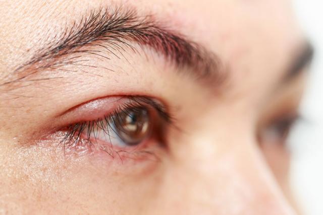 Da li šminka može da bude uzrok pojave èmièka na oku?
