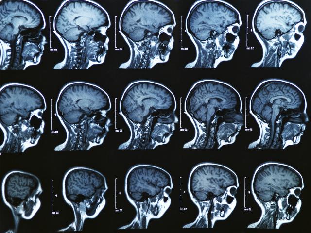 Kod nekih ljudi mozak stari mnogo brže, sada se zna i zašto