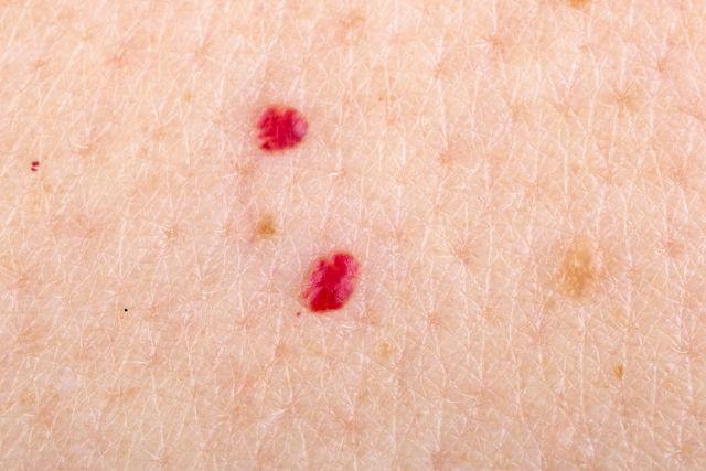 Na koži su vam se pojavile ove crvene tačkice? Evo o čemu je reč