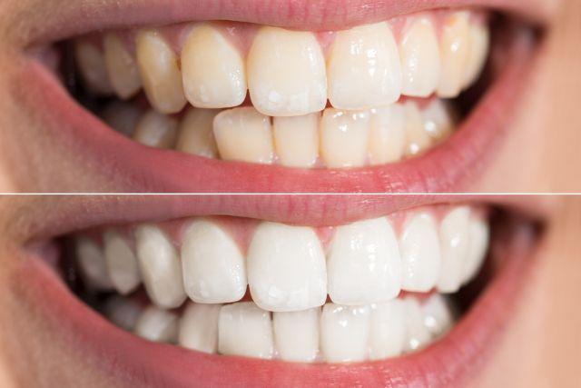 Blistav osmeh bez odlaska kod zubara: Evo kako da uklonite zubni kamenac