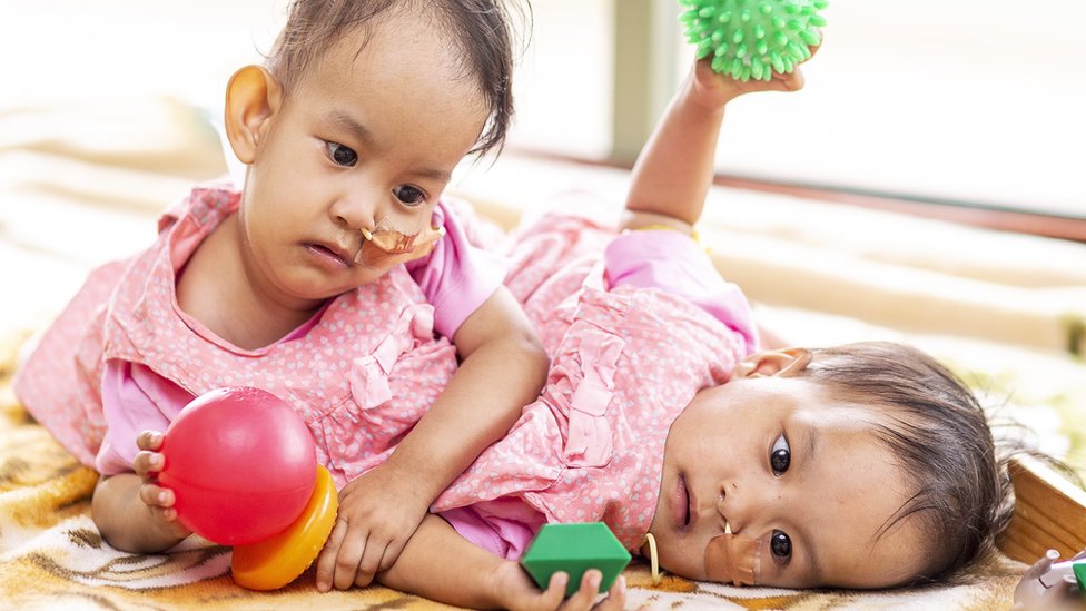 Sijamske bliznakinje: Devojčice razdvojene posle šestočasovne operacije