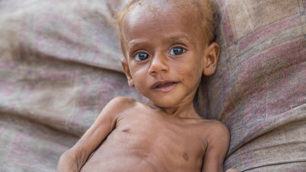 Kriza u Jemenu: 85.000 dece umrlo od gladi