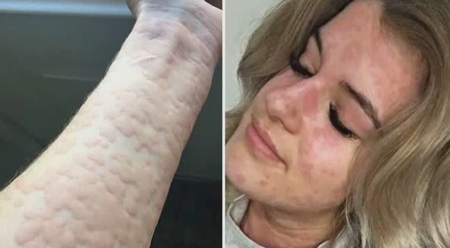 Ima neobièan poremeæaj i zimi ne sme da izaðe iz kuæe