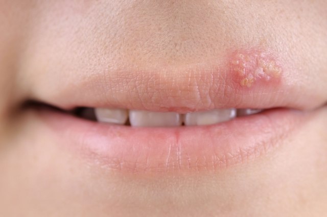 Herpes: Tri saveta za sprečavanje ranica oko usana