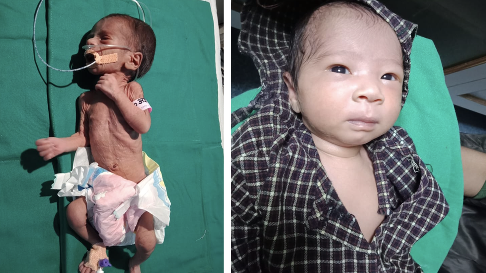 Indija: Prevremeno roðenu bebu zakopali živu - ona se sad oporavlja