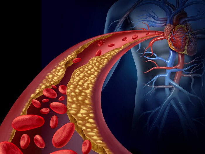 Tihi ubojica: Uzroci nastanka i posljedice visokog kolesterola u krvi