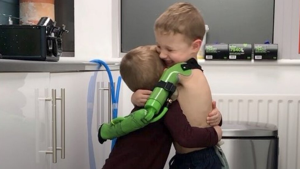 Petogodišnjak dobio "superherojsku" ruku i konaèno zagrlio brata