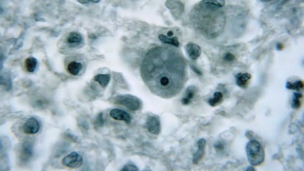 Ameba koja jede mozak: Objavljeno upozorenje na Floridi posle retkog slučaja zaraze