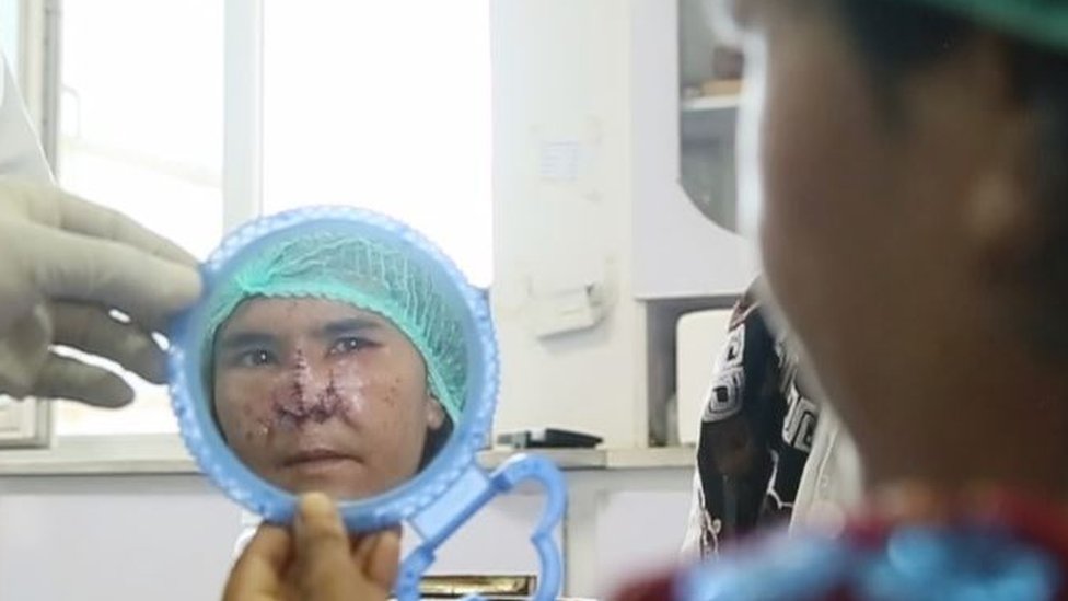 Avganistan, žene i porodièno nasilje: Zarki je muž odsekao nos, a hirurg je besplatno operisao