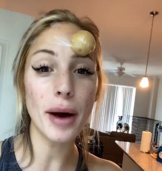 TikTokeri BUBULJICE leče KROMPIROM, a evo šta o tome misli dermatolog... (VIDEO)