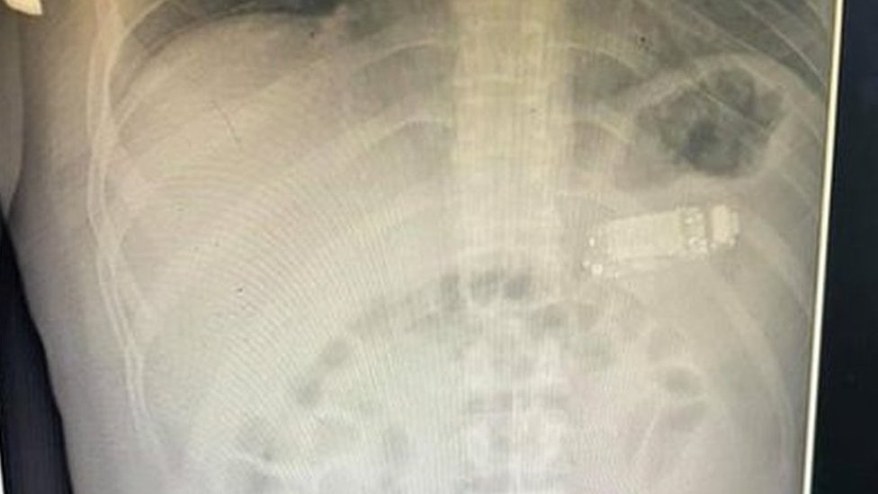 Muškarac u Prištini progutao telefon: Čega su se sve nagledali hirurzi širom sveta