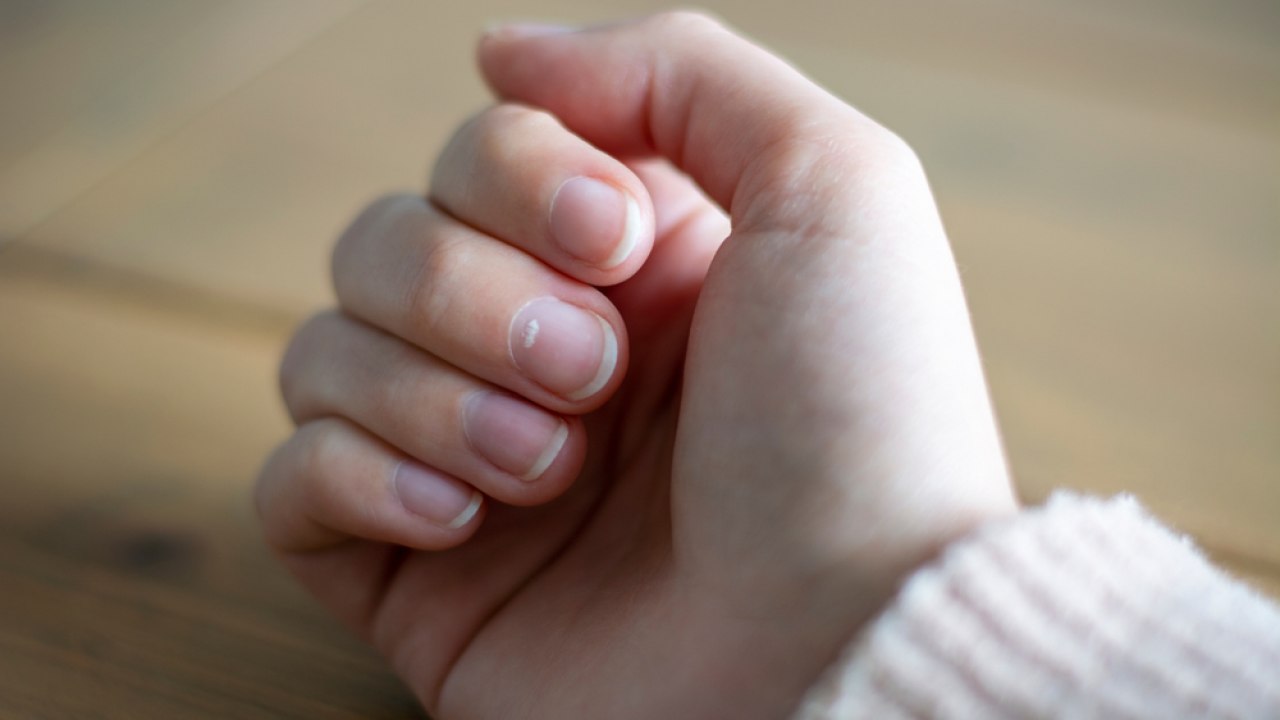 Macchie bianche sulle unghie: quando consultare un medico?