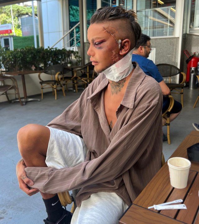 Tiktoker otvoreno priznao: "Uživam u ekstremnim plastiènim operacijama zbog sadržaja i popularnosti"