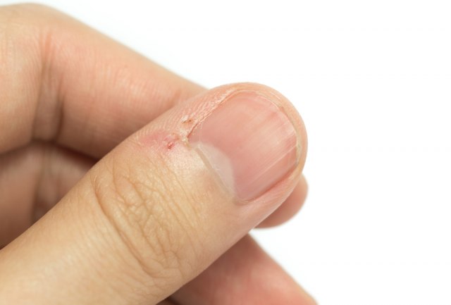 Da li imate vertikalne ili horizontalne NABORE NA NOKTIMA? Evo kada je potrebno da se javite lekaru...