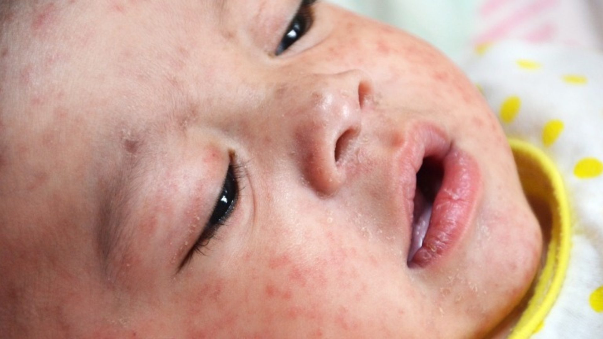 Why is there a measles outbreak in Europe?