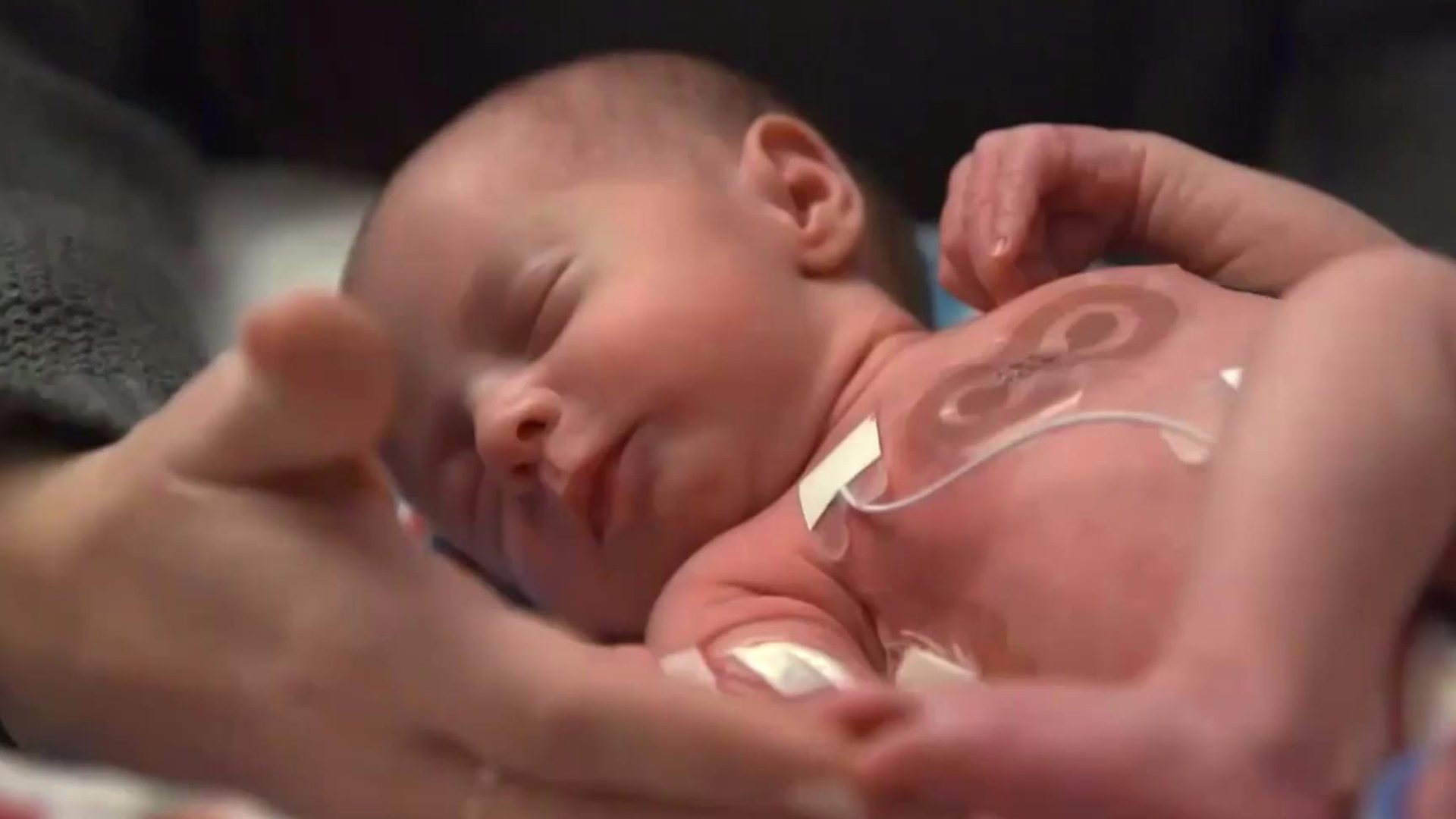 Bežièni flaster pomaže roditeljima da grle svoje prerano roðene bebe