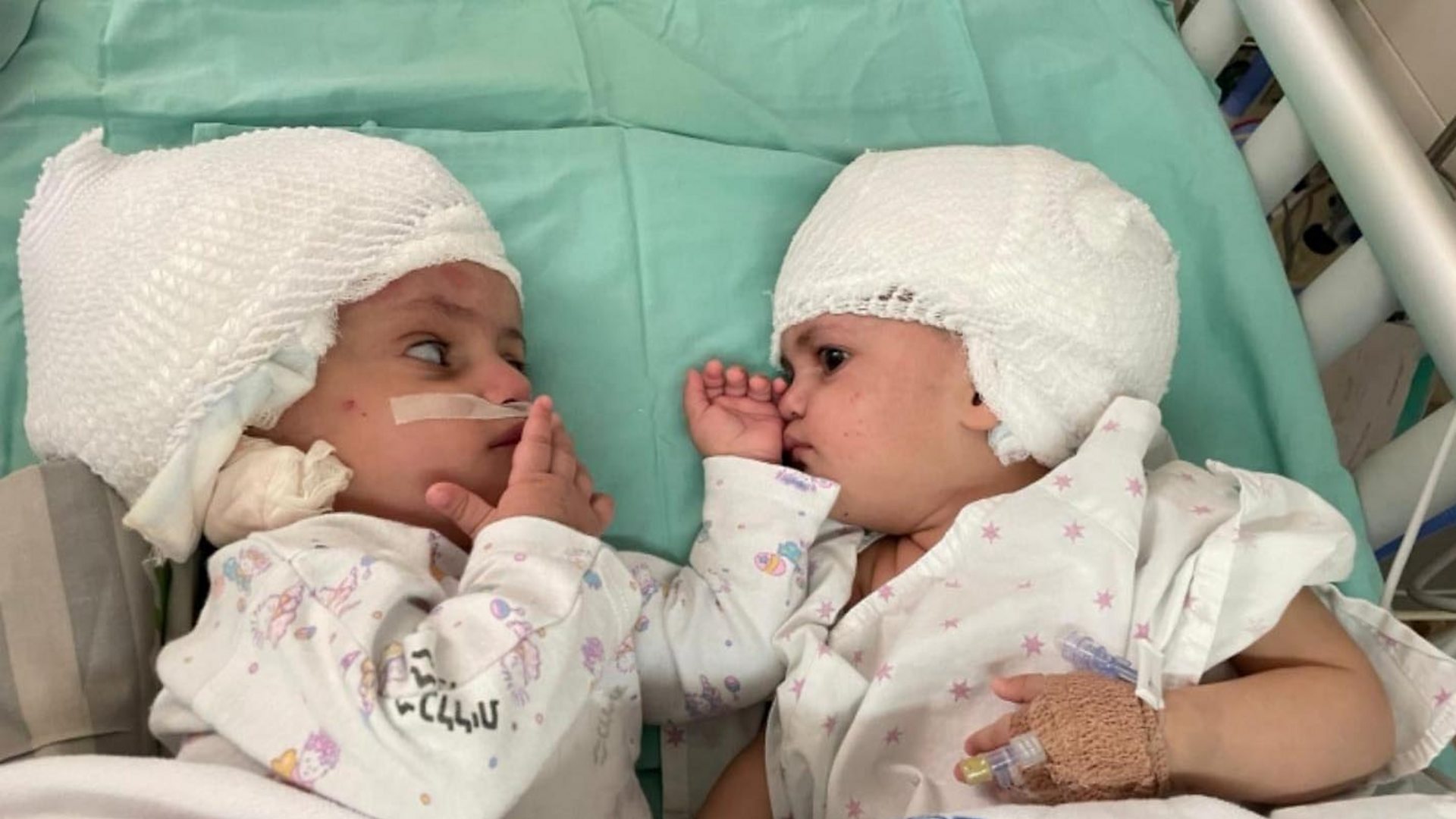 Израел: Сијамске близнакиње се виде по прв&#x