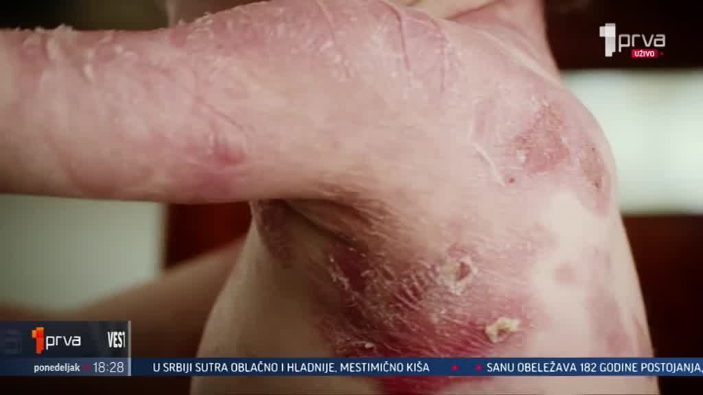 Opasna i teška bolest dece koju zovu leptirima možda će biti izlečiva